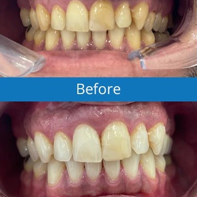 teeth-whitening-1