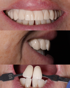 Dental Implants, Portsmouth & Southsea