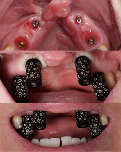 Dental Implants Portsmouth & Southsea